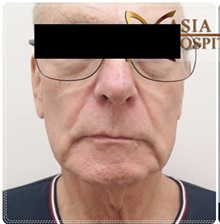 Facelift Before Photo by Tanongsak Panyawirunroj, MD, FRCST; Mueang, Nonthaburee, BM - Case 31803