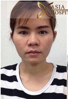 Lip Augmentation/Enhancement Before Photo by Tanongsak Panyawirunroj, MD, FRCST; Mueang, Nonthaburee, BM - Case 31804