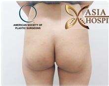 Buttock Implants Before Photo by Tanongsak Panyawirunroj, MD, FRCST; Mueang, Nonthaburee, BM - Case 31807