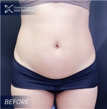Liposuction Before Photo by Tanongsak Panyawirunroj, MD, FRCST; Mueang, Nonthaburee, BM - Case 46842