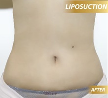 Liposuction After Photo by Tanongsak Panyawirunroj, MD, FRCST; Mueang, Nonthaburee, BM - Case 46843