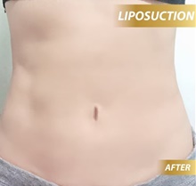 Liposuction After Photo by Tanongsak Panyawirunroj, MD, FRCST; Mueang, Nonthaburee, BM - Case 46844