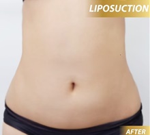 Liposuction After Photo by Tanongsak Panyawirunroj, MD, FRCST; Mueang, Nonthaburee, BM - Case 46846