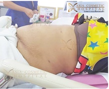 Liposuction After Photo by Tanongsak Panyawirunroj, MD, FRCST; Mueang, Nonthaburee, BM - Case 46847