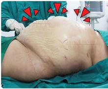 Liposuction Before Photo by Tanongsak Panyawirunroj, MD, FRCST; Mueang, Nonthaburee, BM - Case 46847