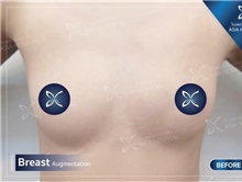 Breast Augmentation Before Photo by Tanongsak Panyawirunroj, MD, FRCST; Mueang, Nonthaburee, BM - Case 46852