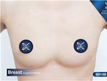 Breast Augmentation Before Photo by Tanongsak Panyawirunroj, MD, FRCST; Mueang, Nonthaburee, BM - Case 46853