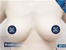 Breast Augmentation Before Photo by Tanongsak Panyawirunroj, MD, FRCST; Mueang, Nonthaburee, BM - Case 46855