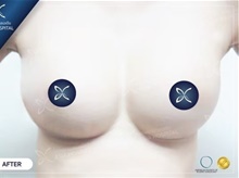 Breast Augmentation After Photo by Tanongsak Panyawirunroj, MD, FRCST; Mueang, Nonthaburee, BM - Case 46856