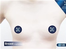 Breast Augmentation Before Photo by Tanongsak Panyawirunroj, MD, FRCST; Mueang, Nonthaburee, BM - Case 46856