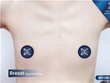 Breast Augmentation Before Photo by Tanongsak Panyawirunroj, MD, FRCST; Mueang, Nonthaburee, BM - Case 46858