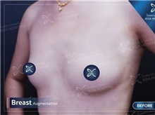 Breast Augmentation Before Photo by Tanongsak Panyawirunroj, MD, FRCST; Mueang, Nonthaburee, BM - Case 46861