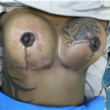 Breast Lift After Photo by Tania Medina, MD; Arroyo Hondo, Santo Domingo, BR - Case 35804