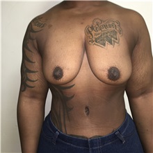 Breast Lift Before Photo by Tania Medina, MD; Arroyo Hondo, Santo Domingo, BR - Case 35804