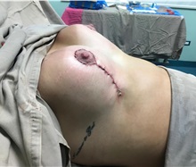 Breast Augmentation After Photo by Tania Medina, MD; ,  - Case 36600