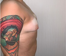 Breast Augmentation Before Photo by Tania Medina, MD; ,  - Case 36600