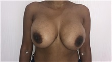 Breast Implant Revision Before Photo by Tania Medina, MD; Arroyo Hondo, Santo Domingo, BR - Case 36601