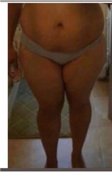 Liposuction Before Photo by Tania Medina, MD; Arroyo Hondo, Santo Domingo, BR - Case 37179