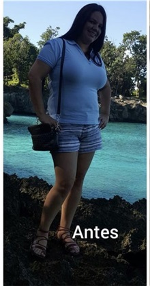Tummy Tuck Before Photo by Tania Medina, MD; Arroyo Hondo, Santo Domingo, BR - Case 37879