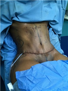 Arm Lift After Photo by Tania Medina, MD; Arroyo Hondo, Santo Domingo, BR - Case 37927