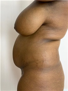 Arm Lift Before Photo by Tania Medina, MD; Arroyo Hondo, Santo Domingo, BR - Case 37927