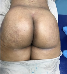 Buttock Lift with Augmentation After Photo by Tania Medina, MD; Arroyo Hondo, Santo Domingo, BR - Case 37979