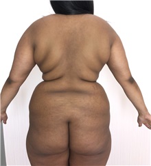 Buttock Lift with Augmentation Before Photo by Tania Medina, MD; Arroyo Hondo, Santo Domingo, BR - Case 37979