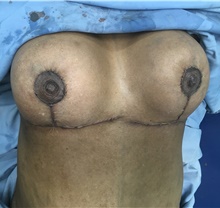 Breast Reduction After Photo by Tania Medina, MD; Arroyo Hondo, Santo Domingo, BR - Case 38697