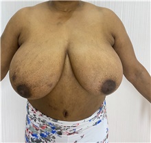 Breast Reduction Before Photo by Tania Medina, MD; Arroyo Hondo, Santo Domingo, BR - Case 38697