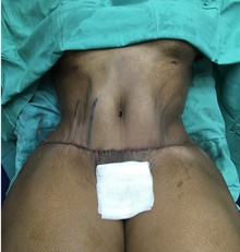 Tummy Tuck After Photo by Tania Medina, MD; Arroyo Hondo, Santo Domingo, BR - Case 38780
