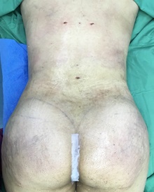 Buttock Lift with Augmentation After Photo by Tania Medina, MD; Arroyo Hondo, Santo Domingo, BR - Case 38858