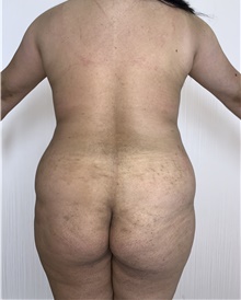 Buttock Lift with Augmentation Before Photo by Tania Medina, MD; Arroyo Hondo, Santo Domingo, BR - Case 38858