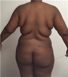 Buttock Lift with Augmentation Before Photo by Tania Medina, MD; Arroyo Hondo, Santo Domingo, BR - Case 39710