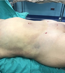 Arm Lift After Photo by Tania Medina, MD; Arroyo Hondo, Santo Domingo, BR - Case 40663