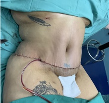 Liposuction After Photo by Tania Medina, MD; Arroyo Hondo, Santo Domingo, BR - Case 42115
