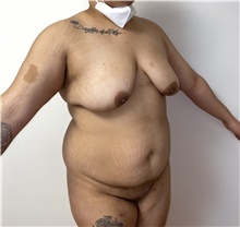 Liposuction Before Photo by Tania Medina, MD; Arroyo Hondo, Santo Domingo, BR - Case 42115