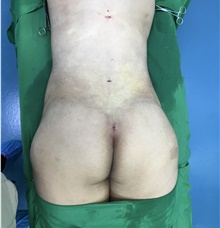 Buttock Lift with Augmentation After Photo by Tania Medina, MD; Arroyo Hondo, Santo Domingo, BR - Case 42545