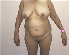 Tummy Tuck Before Photo by Tania Medina, MD; Arroyo Hondo, Santo Domingo, BR - Case 42563