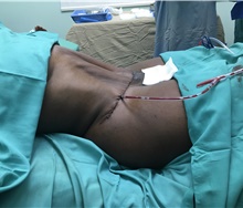 Liposuction After Photo by Tania Medina, MD; Arroyo Hondo, Santo Domingo, BR - Case 42564