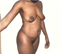 Liposuction Before Photo by Tania Medina, MD; Arroyo Hondo, Santo Domingo, BR - Case 42564