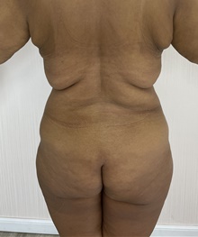 Calf Augmentation Before Photo by Tania Medina, MD; Arroyo Hondo, Santo Domingo, BR - Case 43163