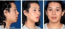 Skull/Facial Bone Reconstruction After Photo by Javier Rossi, MD, FACS; Buenos Aires,  - Case 31382