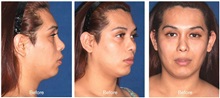 Skull/Facial Bone Reconstruction Before Photo by Javier Rossi, MD, FACS; Buenos Aires,  - Case 31382