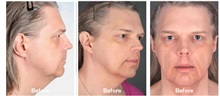 Skull/Facial Bone Reconstruction Before Photo by Javier Rossi, MD, FACS; ,  - Case 31385