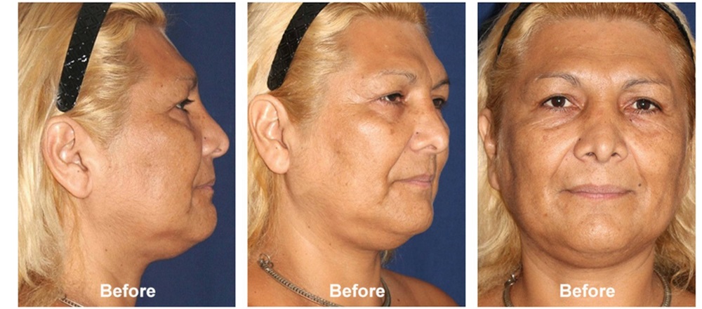 Skullfacial Bone Reconstruction Before And After Photos By Javier