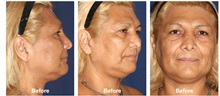 Skull/Facial Bone Reconstruction Before Photo by Javier Rossi, MD, FACS; Buenos Aires,  - Case 31388