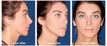 Skull/Facial Bone Reconstruction After Photo by Javier Rossi, MD, FACS; Buenos Aires,  - Case 31391