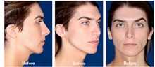 Skull/Facial Bone Reconstruction Before Photo by Javier Rossi, MD, FACS; Buenos Aires,  - Case 31391