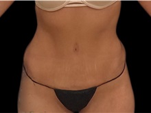 Tummy Tuck After Photo by Steven Hermiz Jr., MD, FACS; Columbia, SC - Case 51614