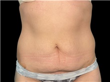 Tummy Tuck Before Photo by Steven Hermiz Jr., MD, FACS; Columbia, SC - Case 51614